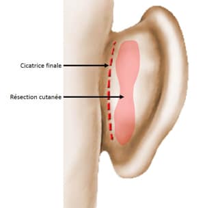 Chirurgie des oreilles décollées
