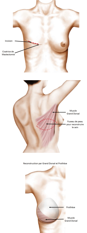 Reconstruction mammaire par lambeau de muscle grand dorsal