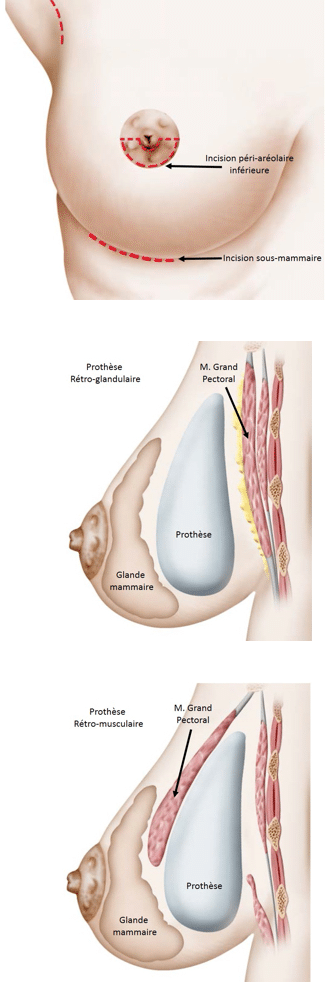 Augmentation mammaire par prothèse mammaire