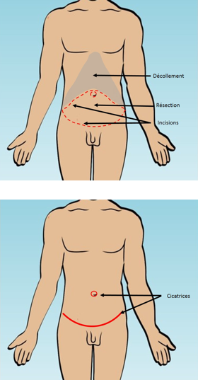 Abdominoplastie ou lifting du ventre
